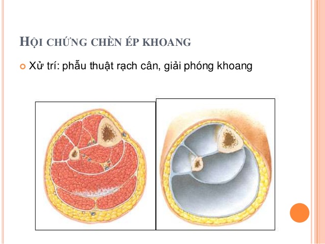 Hội chứng chèn ép khoang - Hình ảnh minh họa